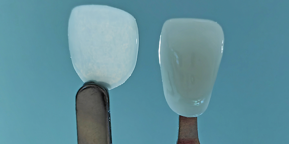 UltraThineer (left) next to a conventional veneer (right) (Courtesy BMF)