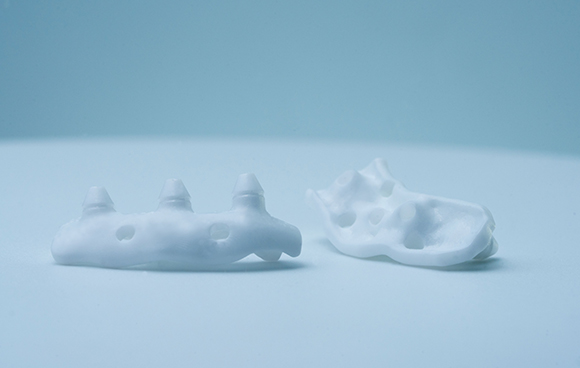A patient at Kepler University Hospital, who had lost multiple dental implants and bone grafts in the past due to his compromised health, received the first zirconia subperiostal implants (Courtesy Lithoz)