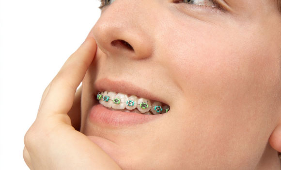 The LightBracket Metal is reported to be the first-of-its-kind patient-specific additively manufactured metal bracket (Courtesy LightForce Orthodontics)